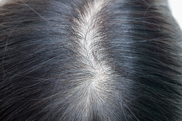 Close up thin hair on scalp of head woman.