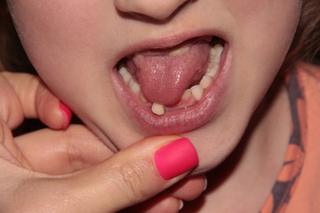 Naklejka premium A child's mouth with a moving tooth. Pink matte nail Polish.