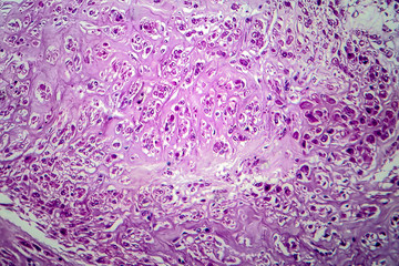 Uterine leiomyoma, also known as fibroids,a benign smooth muscle tumor of the uterus, light...