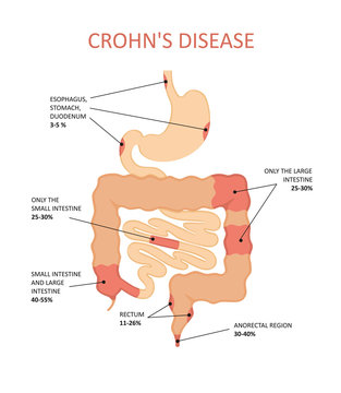 Crohn's disease. Inflammatory bowel disease.