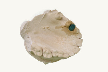 calco in gesso apparato dentale per ricostruzione masticazione