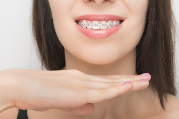 Young woman smile with dental braces. Brackets on the teeth after whitening. Self-ligating brackets with metal ties and gray elastics or rubber bands. Orthodontic teeth treatment
