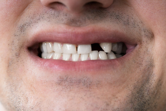 Man With Missing Tooth