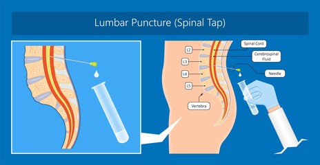 lumbar puncture spinal tap canal diagnostic collect sample patient treat MS tumor exam drug measure pressure CSF lab white blood cell fluid barre back sclerosis cerebri cord hemorrhage column - obrazy, fototapety, plakaty