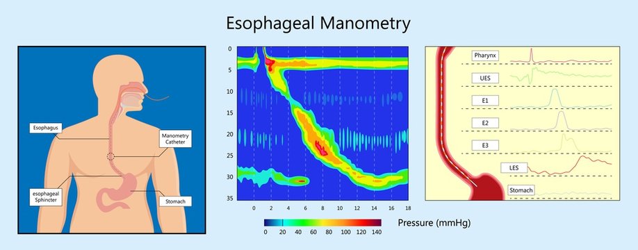 Esophageal Manometry Test Esophageal Diagnose Food High Resolution Impedance HRM Difficulty Swallowing Achalasia Treat Acid