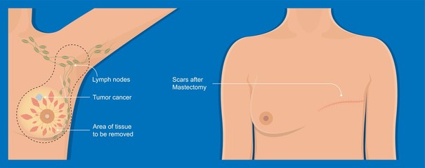 mastectomy breast cancer axillary lymph node dissection chance prevent risk mammography recovery detect diagnosis mammogram symptom infection fluid swelling pain hormonal life bruise bleeding illness