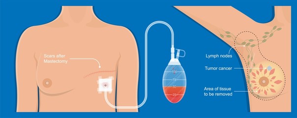 mastectomy breast cancer axillary lymph node dissection chance prevent risk mammography recovery detect diagnosis mammogram symptom infection fluid swelling pain hormonal life bruise bleeding illness