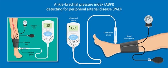 Peripheral artery disease ankle brachial index ABI test limb ischemia diagnosis vascular ABPI blockage - obrazy, fototapety, plakaty