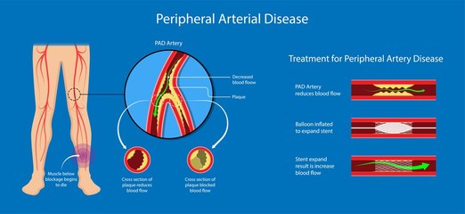 Peripheral artery disease ankle brachial index ABI test limb ischemia diagnosis vascular ABPI blockage - obrazy, fototapety, plakaty