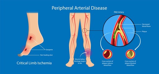 Peripheral artery disease ankle brachial index ABI test limb ischemia diagnosis vascular ABPI blockage