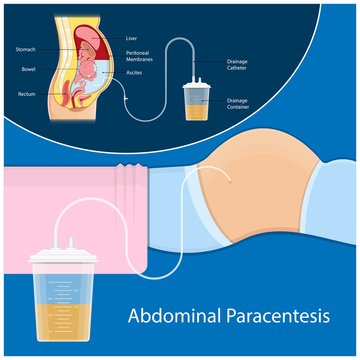 Ascites Paracentesis medical procedure diagnostic abdominal bacteria treatment therapy drainage