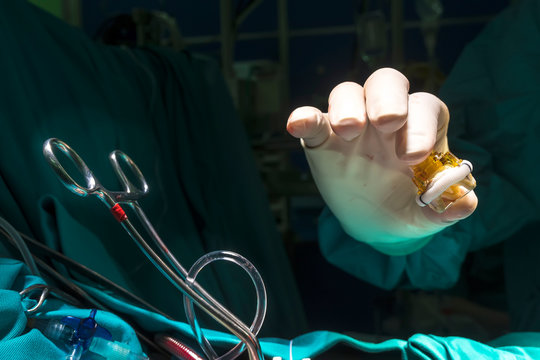 Close Up Image Of Aortic Valve Implant In Surgeon Hand During Open Heart Surgery.