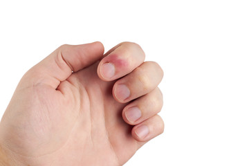 person with finger infection disease. fingernail pain. isolated on white background. copy space