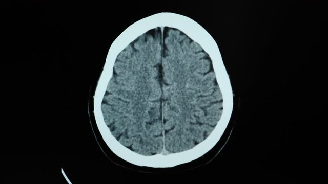CT brain scan of a stroke patient with cerebral hemorrhage. 