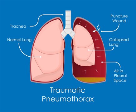 Symptom Spontaneous Iatrogenic Traumatic Pneumothorax Patient with Needle Aspiration Chest Intercostal Drainage Tube Treatment Care Medical Emergency Diagnosis X-Ray Collapsed Lung