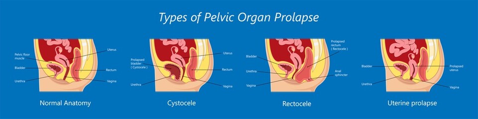 Pelvic floor prolapse type uterine uterus biofeedback pelvic floor treatment stage degree Kegel exercise surgery surgical therapy disorder cystocele urethrocele vaginal vault enterocele urethral exam