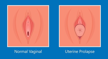 Pelvic floor prolapse type uterine uterus biofeedback pelvic floor treatment stage degree Kegel exercise surgery surgical therapy disorder cystocele urethrocele vaginal vault enterocele urethral exam
