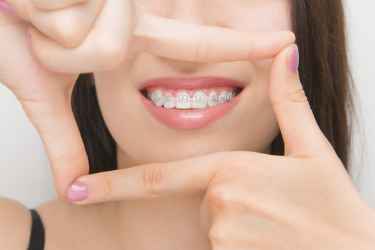 Dental braces in happy womans mouths through the frame. Brackets on the teeth after whitening. Self-ligating brackets with metal ties and gray elastics or rubber bands for perfect smile