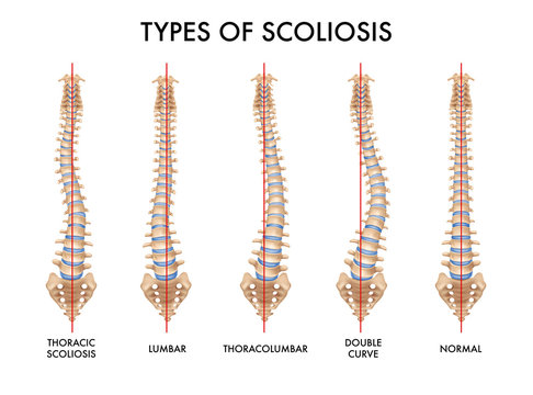 Spine Scoliosis Realistic Set 