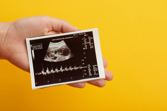 Ultrasound photo of future baby