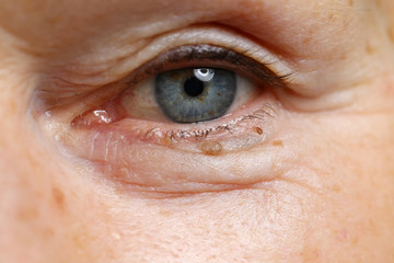 Close-up of senior woman face with wrinkles. Macro shot of sad blue eye of elderly mature female...
