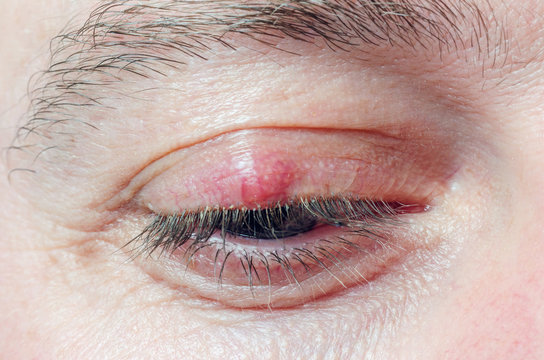 Chalazion on the eyelid of a man close-up