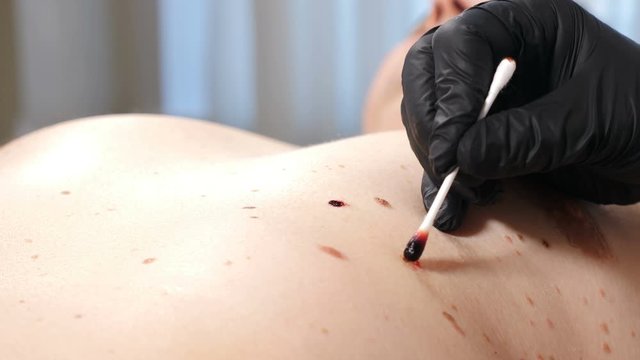 Male client in beauty clinic. surgeon in black gloves cauterize wound after removing of papillomavirus. Electrocoagulation of papillomas. dermatological cure. Doctor making laser removal of growths on