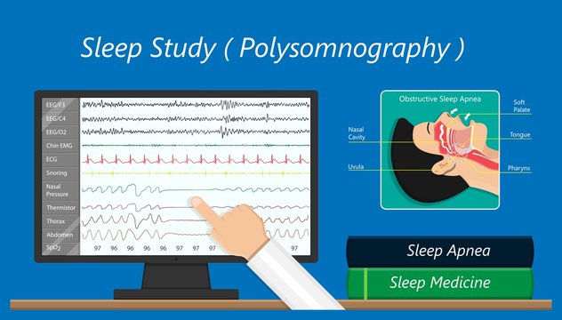 PSG Sleep Study Test Apnea Diagnose Periodic Limb Movement Disorder Positive Airway Pressure CPAP Restless Leg Syndrome Epworth Sleepiness Scale