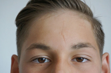Forehead close up teenager skin imperfection