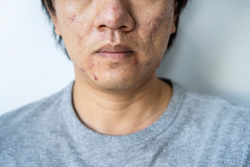 Young asian man with problematic from acne