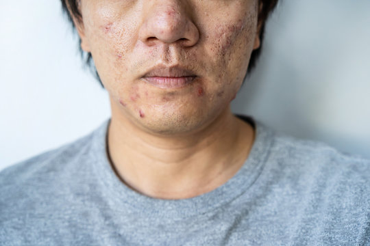 Young asian man with problematic from acne