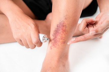 Asian women have bruise on leg from accident and use medicine cream on her skin, on white...