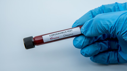 Obraz premium Positive COVID-19 test and laboratory sample blood testing for diagnosis