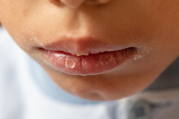 Closeup of chapping dry lips and cracked skin around the mouth of a young boy