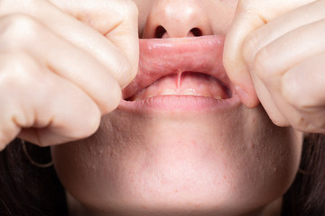 Medical inspection of the superior labial frenulum to evaluate the need for frenectomy oral surgery