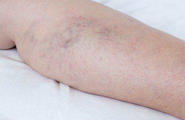 varicose veins on the legs of a person, thrombophlebitis, anatomical
