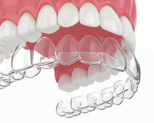 3d render of upper jaw with invisalign removable retainer © Aleksandra Gigowska