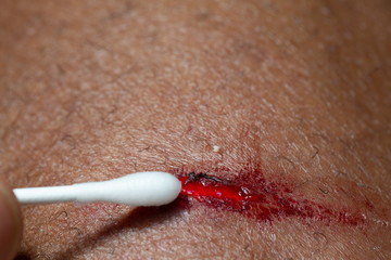 Fresh wound being cleaned with cotton bud to prevent infection