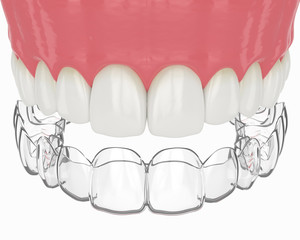 3d render of upper jaw with invisalign removable retainer © Aleksandra Gigowska