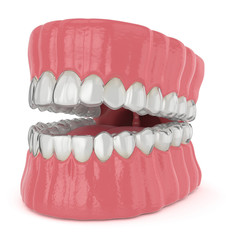 3d render of jaw with invisalign removable retainers