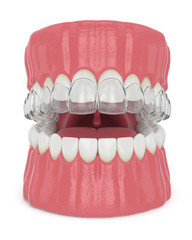 3d render of jaw with invisalign removable retainer