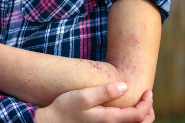 a wounds atepic dermatitis in the hands of a child