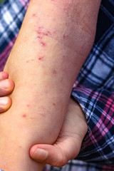 a wounds atepic dermatitis in the hands of a child