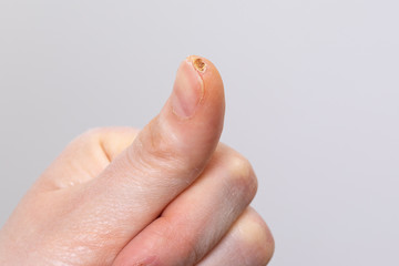 Detail of injured thumb tip wound healing process. Neutral plain background with plenty of copy...