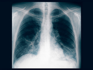 X- ray of the lungs of an adult male with bilateral pneumonia