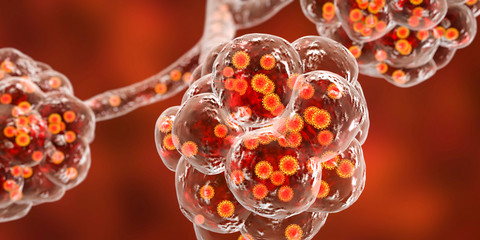 Coronavirus pneumonia, alveoli filled with Covid-19 Novel Chinese Wuhan coronavirus, 2019-nCoV, 3D illustration