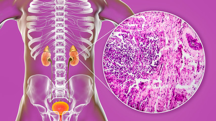 Chronic glomerulonephritis, 3D illustration showing pale contracted coarsely granular kidneys and light micrograph showing glomerulosclerosis, interstitial fibrosis and lymphocytic inflammation