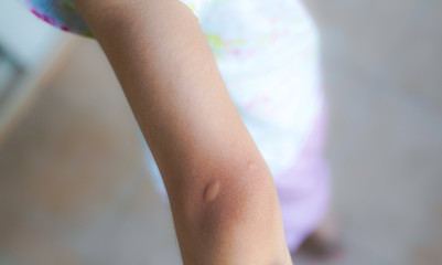 Mosquito bites legs of a woman