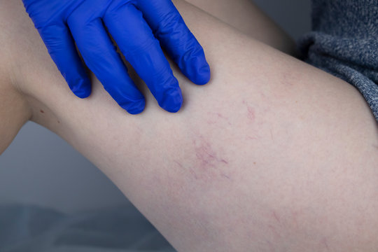 A vascular surgeon examines a leg with varicose veins. Vascular network and blood vessels are shown close-up through a magnifying glass. Preparation for laser treatment and sclerotherapy