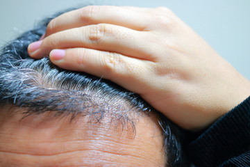 薄毛で悩む白髪交じりの頭皮